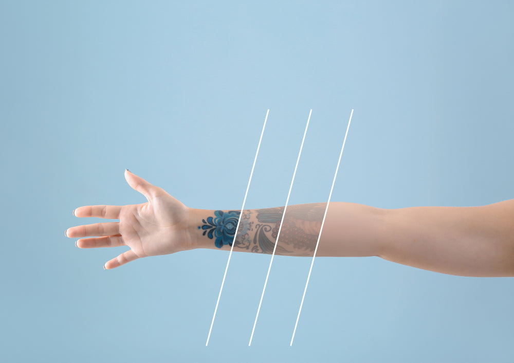 How does tattoo removal work