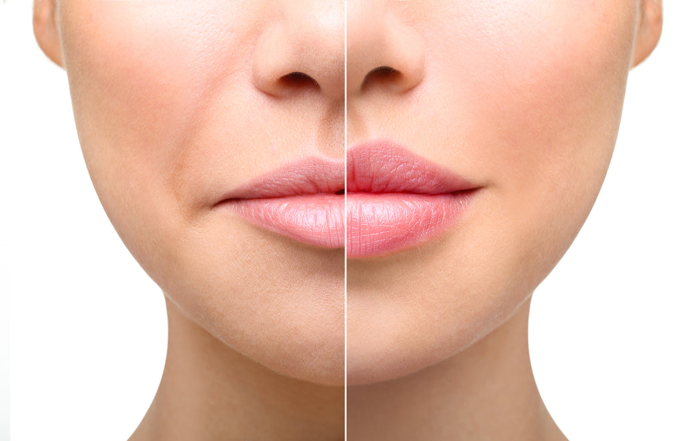 How To Massage Lip Filler Lumps